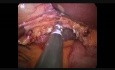 SILS Cholecystectomy with Gelpoint and Articulated Hook