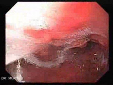 Scirrhous Gastric Carcinoma - Endoscopy (12 of 47)