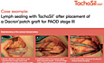 Lymph Sealing with TachoSil® After Placement of a Dacron® Patch Graft for PAOD Stage III, Jörg Ukkat