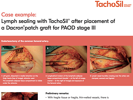 Lymph Sealing with TachoSil® After Placement of a Dacron® Patch Graft for PAOD Stage III, Jörg Ukkat