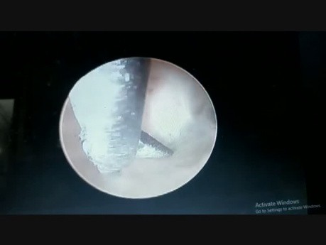Hystroscopic Septum Resection with Scissors