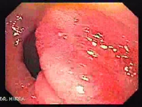 Pre - Pyloric Ulcer - Endoscopy (2 of 9)