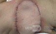 Latissimus Dorsi Flap Reconstruction 