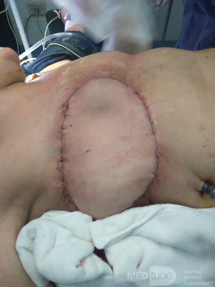 Latissimus Dorsi Flap Reconstruction 