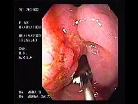 Tubulovillous Tumor (1 of 2)