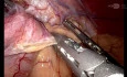 OAGB + Hiatus Hernia Repair Robotic