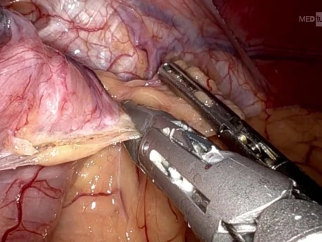 OAGB + Hiatus Hernia Repair Robotic