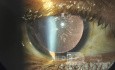 Snowflake Cataract