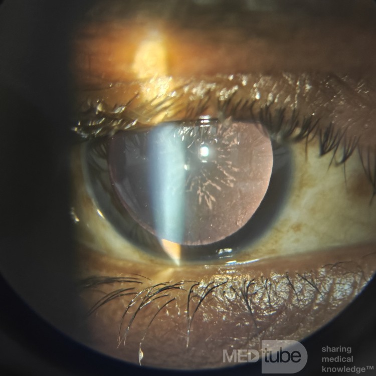 Snowflake Cataract