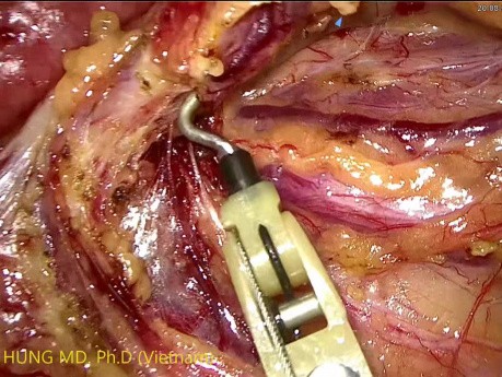 Lap High Anterior Resection for Huge Sigmoid Colon Tumor