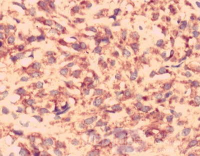Gastrointestinal Stromal tumor (GIST) (61 of 65)