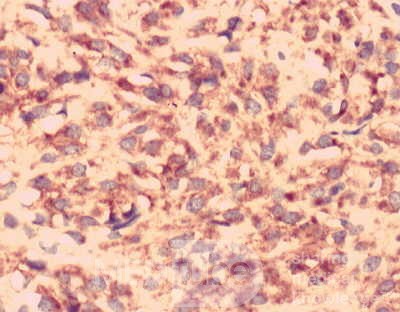 Gastrointestinal Stromal tumor (GIST) (61 of 65)