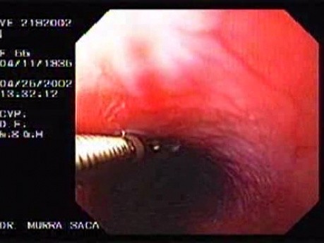 Endoscopic Look at The Papilloma of the Middle Third of the Esophagus