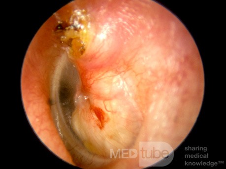 Large Cholesteatoma in Middle Ear