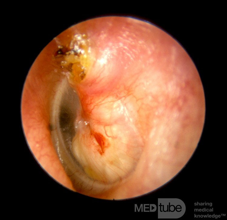 Large Cholesteatoma in Middle Ear
