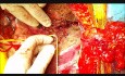 ALPPS Procedure