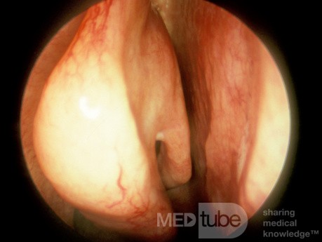 The Superior Turbinates and the Superior Meatus [right]