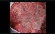 Laparoscopic Groin Hernia Repair, Step 9: Mesh Fixation by Tacs