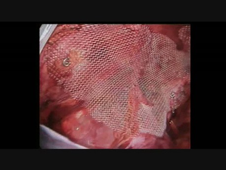 Laparoscopic Groin Hernia Repair, Step 9: Mesh Fixation by Tacs