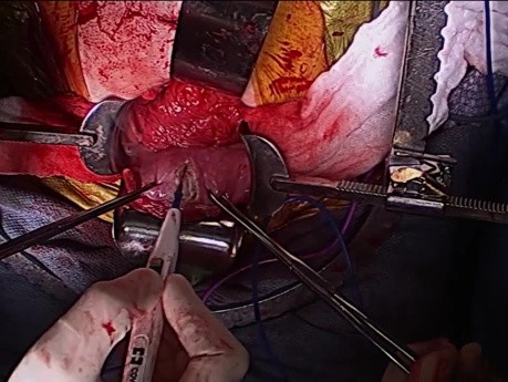 Hand-assisted Laparoscopic Right Colon Mobilization For Continent Cutaneous Ileal Cecocystoplasty 