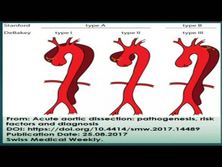 Aortic Dissection: Transesophageal Echocardiography (Echo), Chest Ct Angiography and Treatment