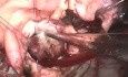 Excision of Cardiac tumor