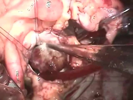 Excision of Cardiac tumor