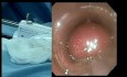 StomaphyX in Bariatric surgery