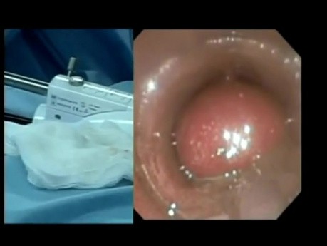 StomaphyX in Bariatric surgery