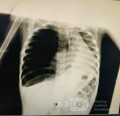 Right Lung Pneumothorax in a 3 Years old Male