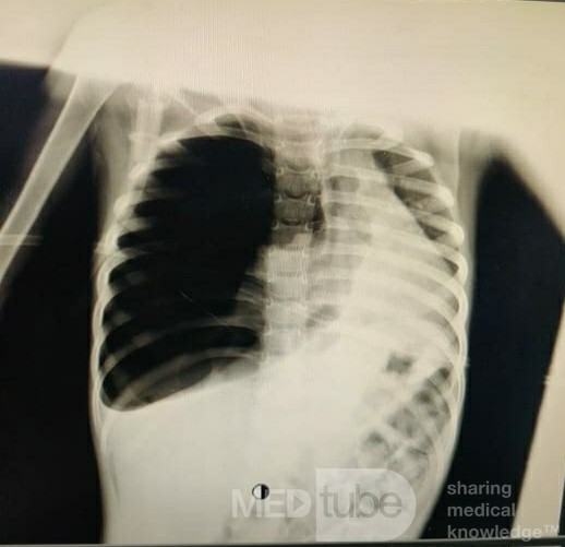 Right Lung Pneumothorax in a 3 Years old Male