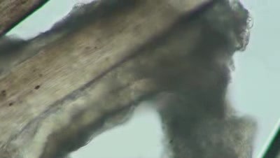 Alopecia - Human hair