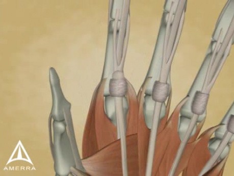 Trigger Finger 3D Medical Animation 