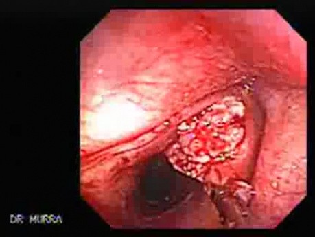 Egzophytic squamous cell carcinoma of the larynx - endoscopic biopsy 3/3