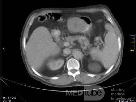 Gastrointestinal Stromal tumor (GIST) (11 of 13)