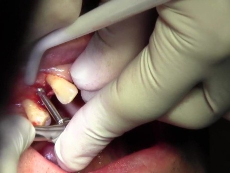 Implant Placement #5, Osteotomy Prep, Implant Insertion, Flap Advancement