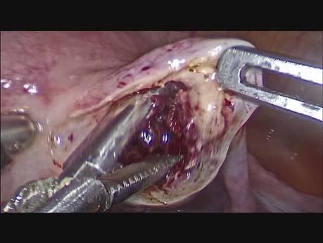 Cornual Ectopic Pregnancy