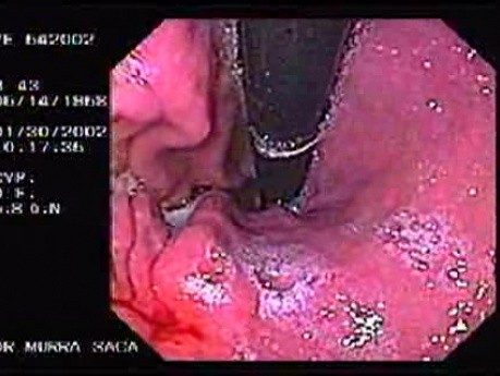 Early Gastric Carcinoma With Signet Ring Cells - Endoscopy (3 of 3)
