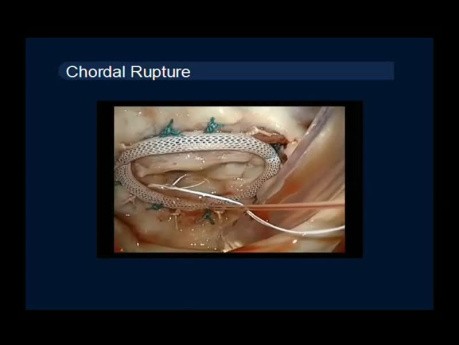 10 Cases of Mitral Valve Re-repair Surgical Techniques