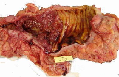 Adenocarcinoma of the Transverse Colon (10 of 15)