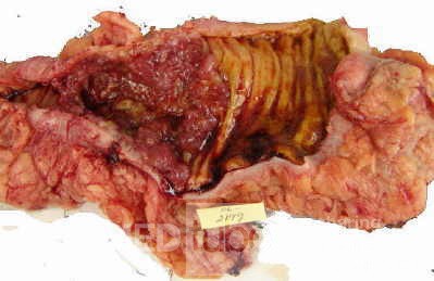 Adenocarcinoma of the Transverse Colon (10 of 15)
