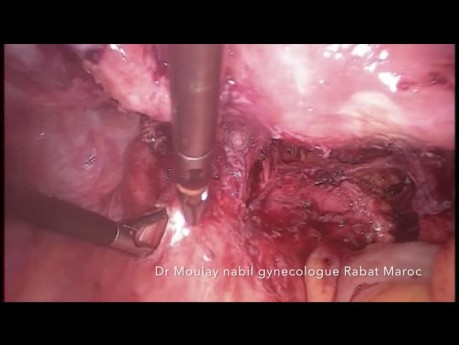 Laparoscopy for Severe Recto-vaginal Endometriosis