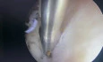 Endometrial Polyp