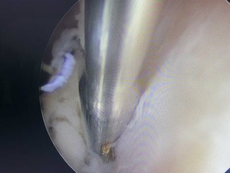 Endometrial Polyp