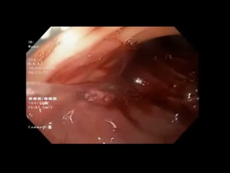 Bleeding in Patient with Mega Stent