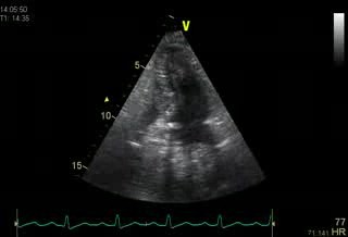 Left Atrial Compression