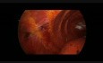 Thoracoscopy in the Nuss Procedure in a Patient with a Funnel Chest