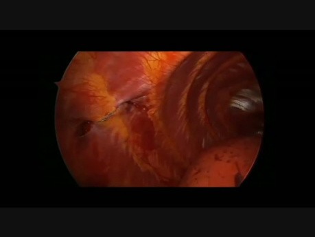 Thoracoscopy in the Nuss Procedure in a Patient with a Funnel Chest