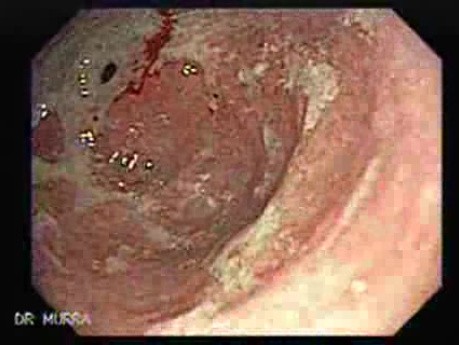 Adenocarcinoma of the cardias (2 of 14)