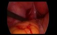 Accident Ectopic Pregnancy - LUS (laparoscopic ultrasonography)